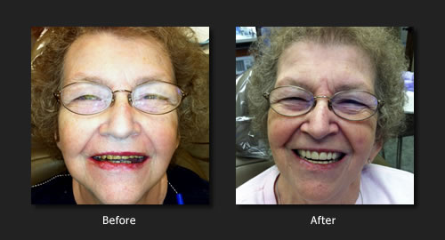 Smile Makeover